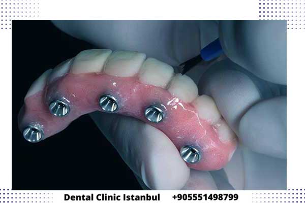 ألم بعد زراعة الأسنان في تركيا – الأسباب و طرق العلاج