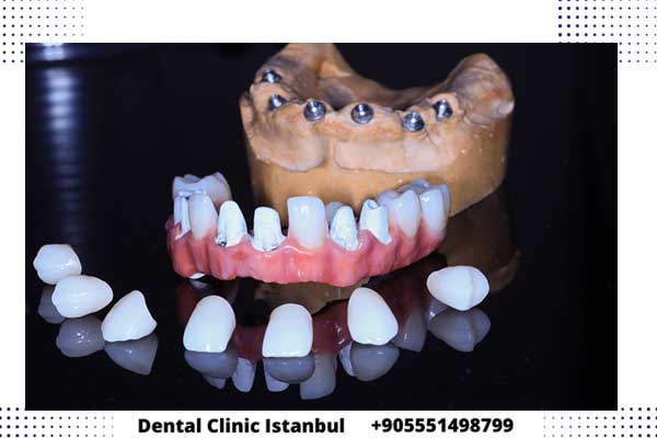 أنواع زرعات الأسنان السويسرية في تركيا – المميزات و العيوب و الأسعار
