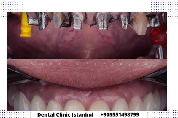 أنواع زرعات الأسنان الكورية في تركيا – المميزات و العيوب و الأسعار
