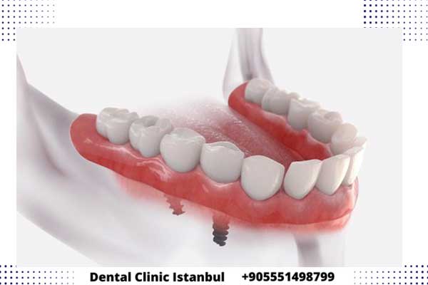 اسعار مقبولة لزراعة الاسنان في تركيا ضمن عيادة اسطنبول نيشانتشي