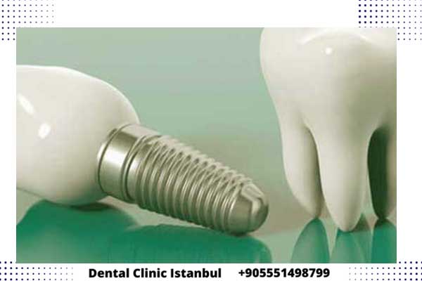 افضل انواع زراعة الاسنان في تركيا - كيف تختار زرعة الأسنان المناسبة