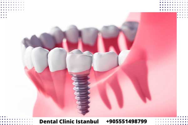 العمر الافتراضي لزراعة الاسنان في تركيا - نصائح للحفاظ على زرعة الأسنان