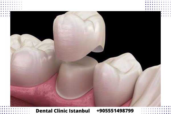 الفرق بين زراعة الاسنان وتركيب الاسنان في تركيا و أهم النصائح