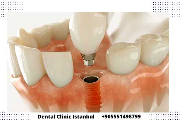 انا خايفه من زراعة الأسنان لهذا اخترت الدكتور وحيد في تركيا