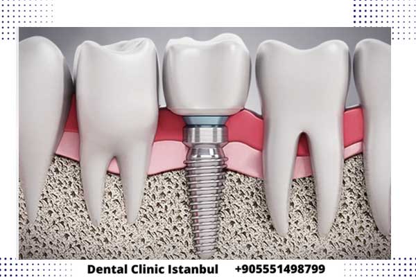 ايهما افضل زراعة الاسنان او التلبيس للاسنان في تركيا و ما الفرق ؟