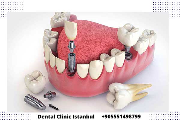 بعد عملية زراعة الاسنان في تركيا – أهم النصائح لنتائج دائمة