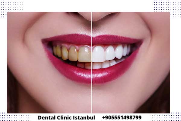 تبييض الاسنان في تركيا - الأنواع و الأسعار و التقنيات المناسبة لك
