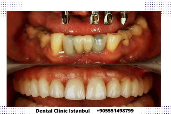 تجارب زراعة الأسنان في تركيا و النتائج بكل تفاصيلها