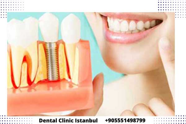 تجربتي مع زراعة الأسنان في تركيا و أفضل طبيب أسنان