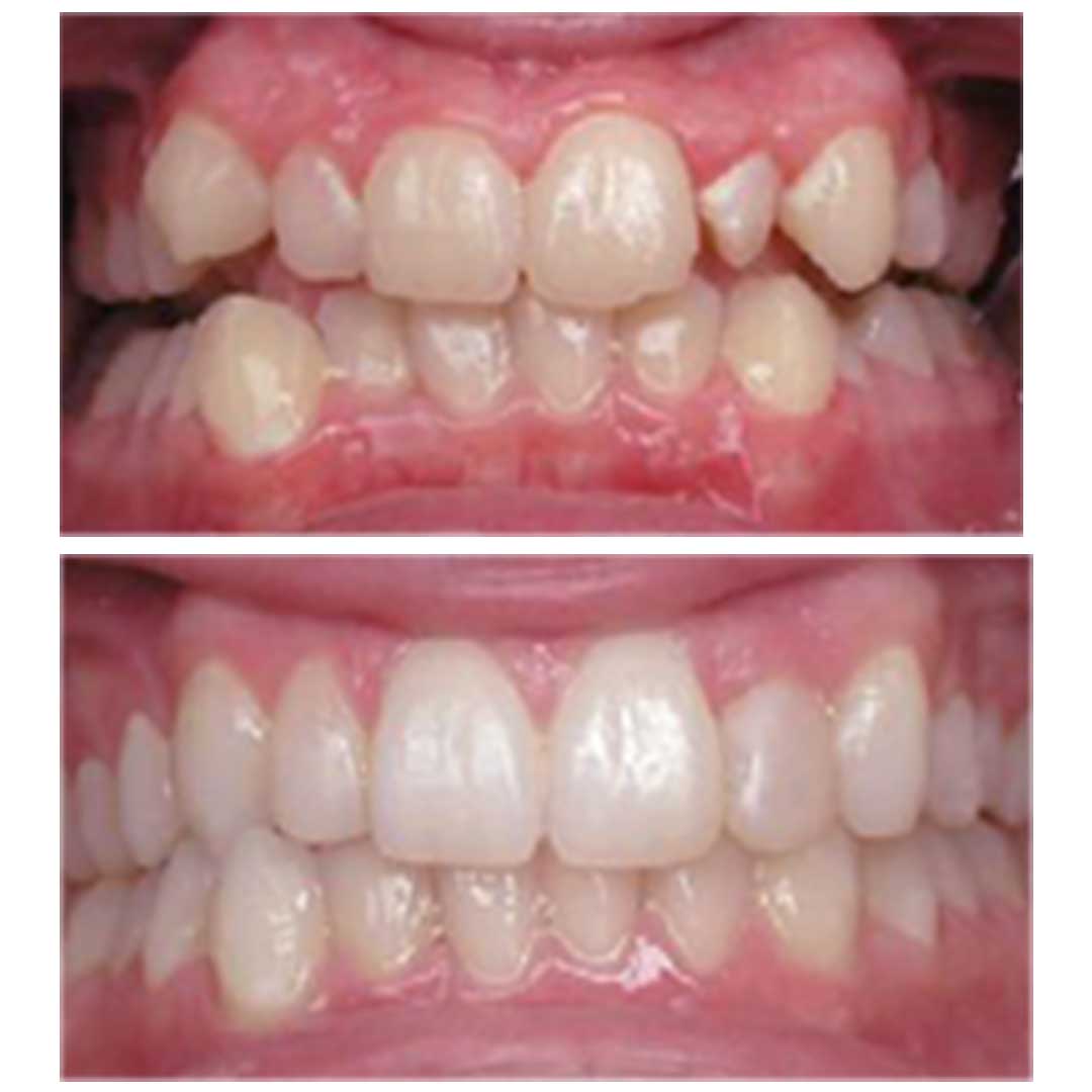حالات تقويم اسنان قبل وبعد
