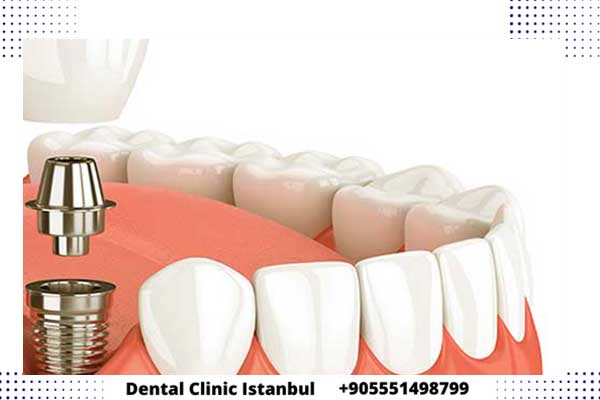 زراعة الأسنان بدون جراحة في تركيا - الميزات و العيوب