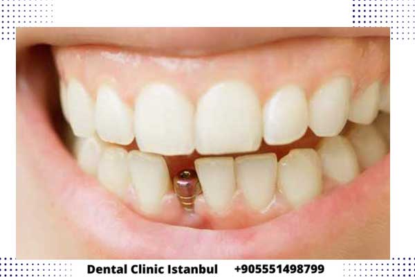 زراعة الأسنان في يوم واحد في تركيا ضمن أفضل عيادات الأسنان