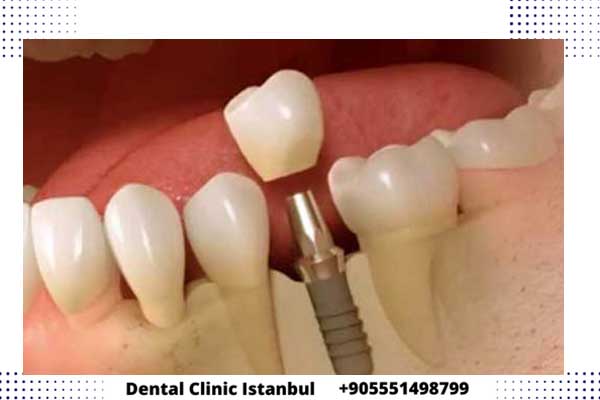 زراعة الاسنان الفورية في تركيا – الخطوات و التكاليف و أهم التفاصيل