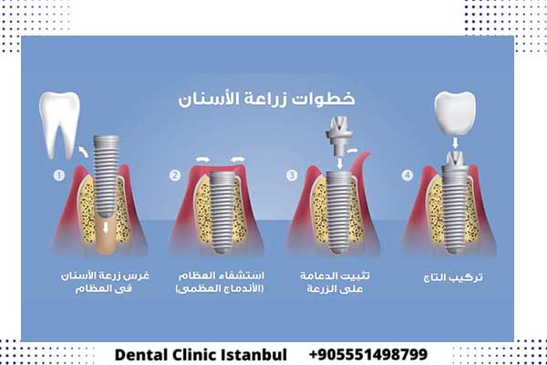 زراعة الاسنان في تركيا - التقنيات وتكلفة زرع السن و التاج 