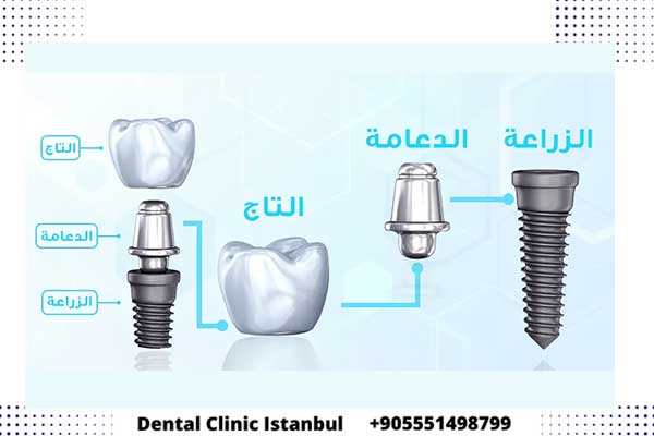 زراعة الاسنان في تركيا - التقنيات وتكلفة زرع السن و التاج 