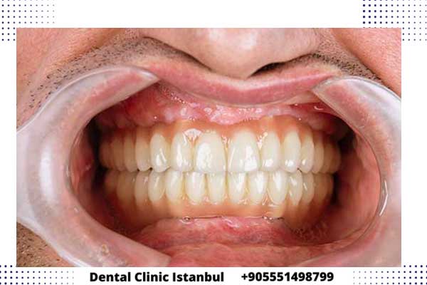 زراعة الاسنان في تركيا - التقنيات وتكلفة زرع السن و التاج