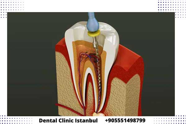 زراعة عصب الأسنان في تركيا متى يكون ضرورويا وكم يكلف
