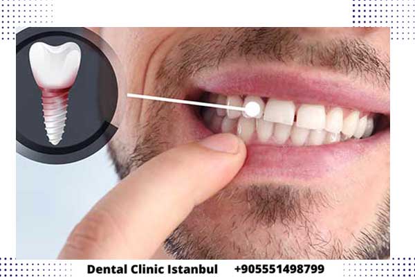 شروط زراعة الأسنان في تركيا - أهم النصائح لنجاح زرعة الأسنان