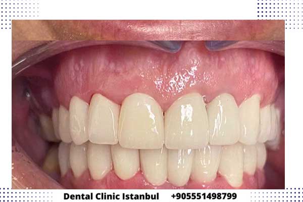 شكل زراعة الاسنان في تركيا بالصور قبل وبعد تغير شكل الاسنان