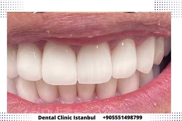 علامات نجاح زراعة الاسنان في تركيا و أهم النصائح لزرع أسنان ناجح