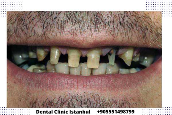 عملية زراعة الاسنان في تركيا – الخطوات و أحدث التقنيات