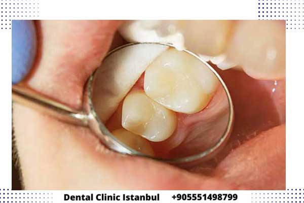 كيفية زراعة الاسنان في تركيا - الخطوات بالتفصيل وأهم النصائح