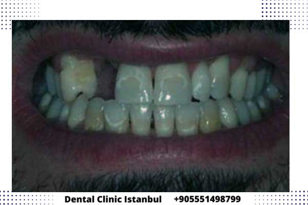 مدة زراعة الأسنان بعد الخلع في تركيا - أهم النصائح قبل وبعد الزرع للأسنان