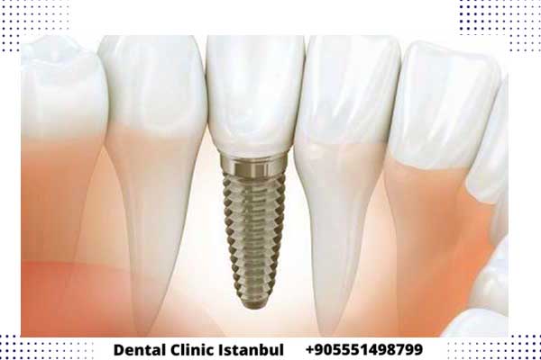 مدة زراعة الأسنان في تركيا و تفاصيل سياحة الأسنان العلاجية