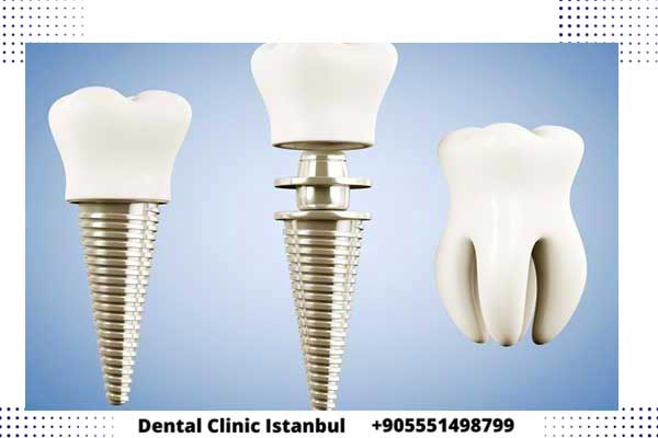 مراحل زراعة الأسنان في تركيا أهم النصائح قبل وبعد زرع الاسنان