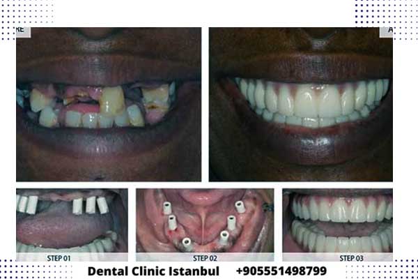 مراحل زراعة الاسنان بالصور في تركيا و أهم النصائح لنجاح العملية