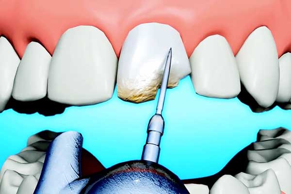 أسعار تصليح الأسنان في تركيا: دليل شامل للحصول على أفضل العلاجات بأقل التكاليف