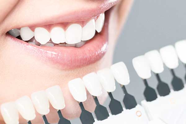 اسعار تجميل الاسنان في تركيا: دليل شامل للحصول على الابتسامة المثالية