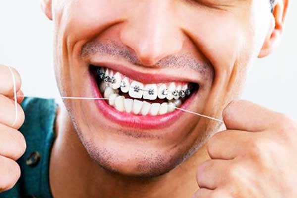 اسعار تقويم الاسنان في تركيا: دليل شامل للحصول على الابتسامة المثالية
