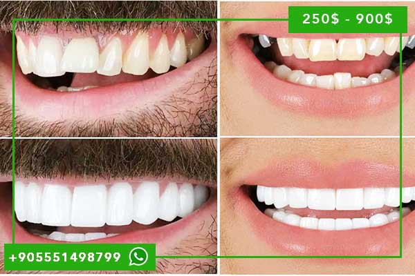 أفضل عيادات الاسنان في تركيا: دليلك الشامل للعناية بأسنانك