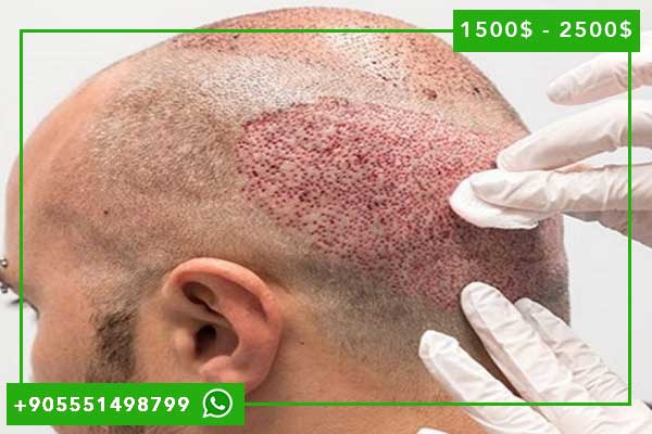 camilia clinic hair transplant in turkey زراعة الشعر في تركيا : تجربة زراعة الشعر الإيجابية في عيادة كاميليا بتركيا