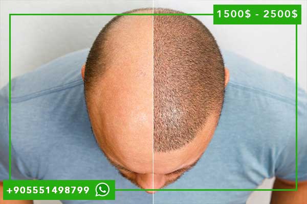 المركز الاوروبي لزراعة الشعر تركيا اسطنبول: معلومات وأسعار وتجارب