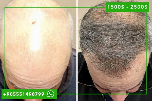 تجربتي زراعة الشعر في تركيا