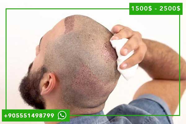 تكلفة زراعة الشعر في تركيا بالجنيه المصري: دليل شامل ومفصل