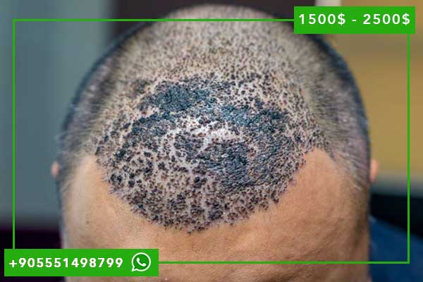 تكلفة زراعة الشعر في تركيا بالدينار الأردني: دليل شامل للباحثين عن الجودة والاقتصادية