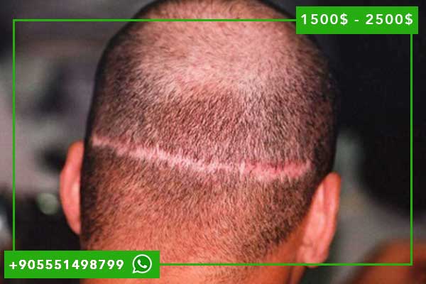 كل ما تحتاج لمعرفته حول تكلفة زراعة الشعر في تركيا بالدينار التونسي