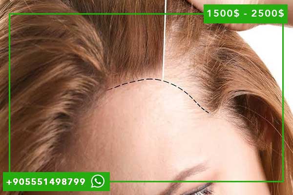 تكلفة زراعة الشعر للنساء في تركيا: دليل شامل 2024