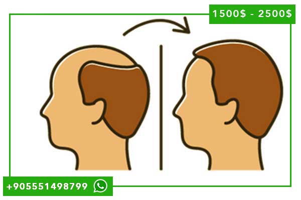 زراعة الشعر بالخلايا الجذعية في تركيا