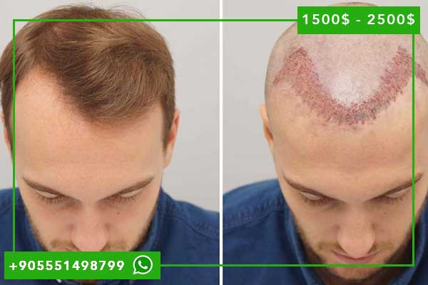 زراعة الشعر بتقنية dhi في تركيا: دليل شامل وأسعار مغرية لعام 2024