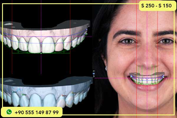 مقارنة بين أسعار ابتسامة هوليود في تونس وتركيا, تكلفة ابتسامة هوليود في تركيا, أفضل عيادات ابتسامة هوليود في تركيا, أسعار ابتسامة هوليود في تونس, لماذا تختار تركيا لابتسامة هوليود, الفرق بين ابتسامة هوليود في تركيا وتونس