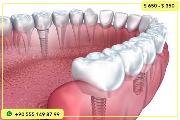 مقارنة بين أسعار زراعة الأسنان في تونس وتركيا: 7 أسباب لاختيار تركيا ✨