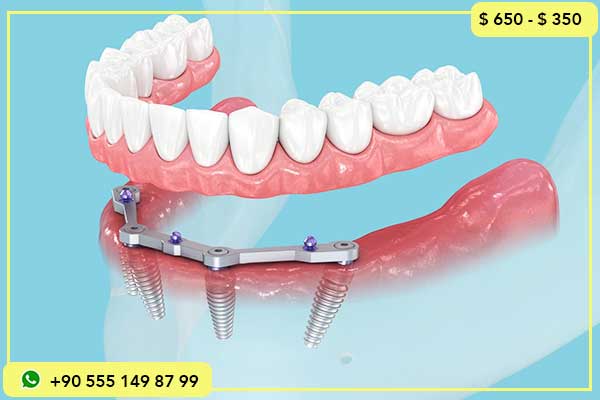 مقارنة بين أسعار زراعة الأسنان في العراق وتركيا ولماذا تختار تركيا؟