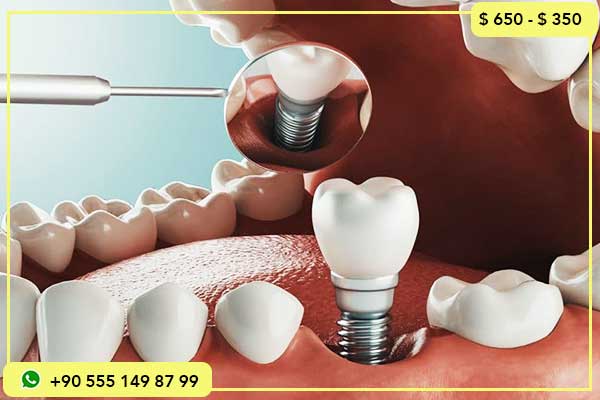 مقارنة بين أسعار زراعة الأسنان في كندا وتركيا: 7 أسباب لاختيار تركيا 🦷🌍