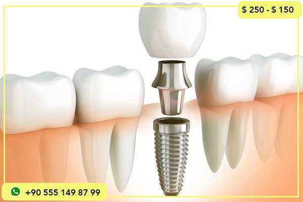 دليلك الشامل إلى زراعة الأسنان في تركيا مع الترجمة الفورية
