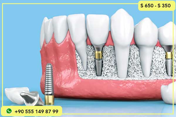 تكلفة زراعة الأسنان في إسطنبول: دليل شامل حول الأسعار والتقنيات والأنواع