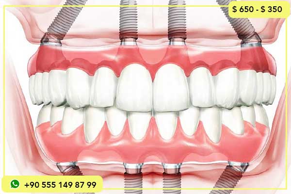 تقنية زراعة الأسنان الفورية: كل ما تحتاج معرفته عن الحل السحري لاستعادة ابتسامتك!